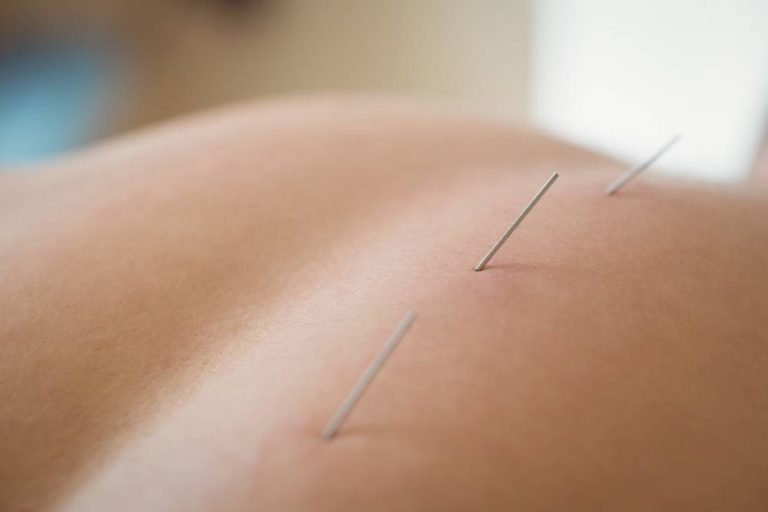 Exploring the Benefits of Dry Needling A Comprehensive Guide to Dry Needling in Melton.